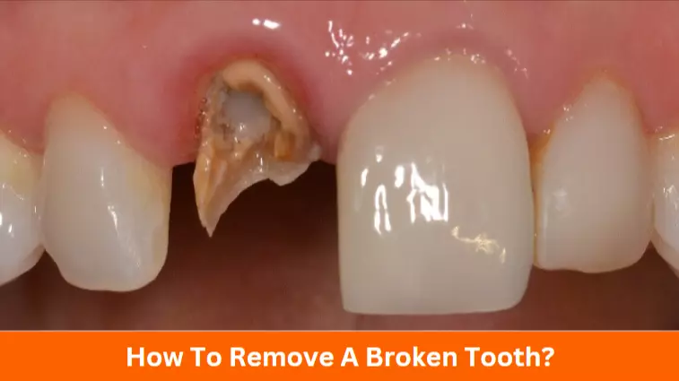 How to Remove a Broken Tooth